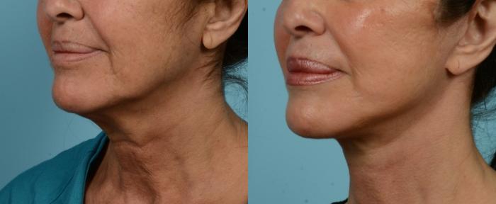 Before & After (cropped) Neck Lift by Dr. Mustoe Case 975 Left Oblique View in Chicago, IL