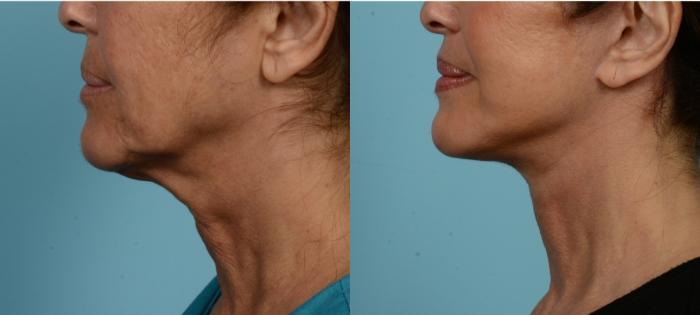 Before & After (cropped) Neck Lift by Dr. Mustoe Case 975 Left Side View in Chicago, IL