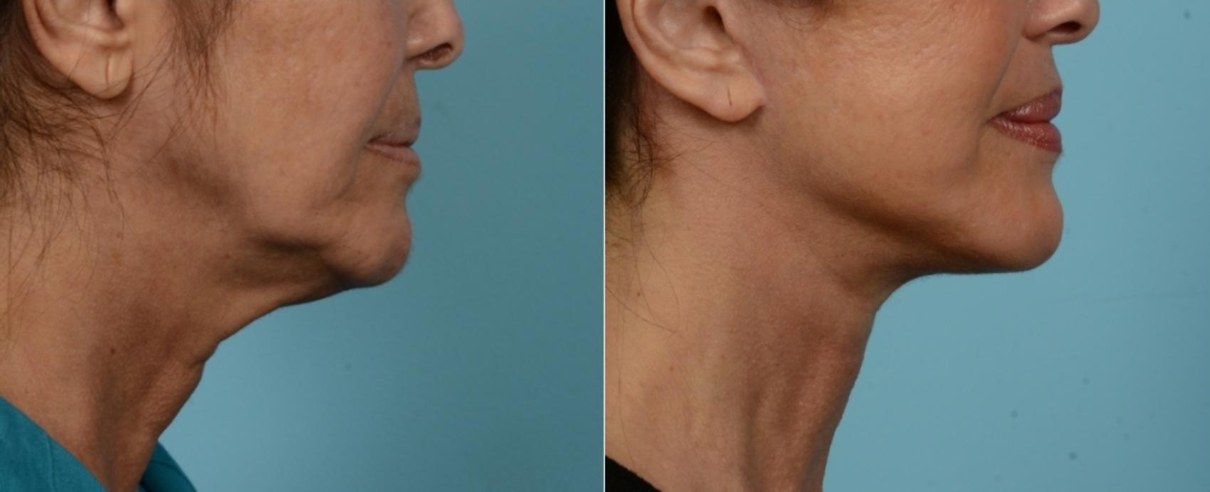 Before & After (cropped) Neck Lift by Dr. Mustoe Case 975 Right Side View in Chicago, IL