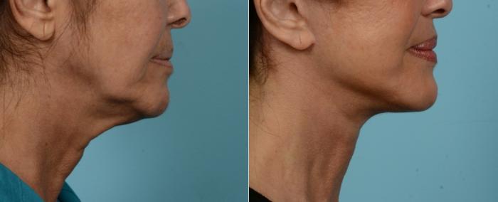 Before & After (cropped) Neck Lift by Dr. Mustoe Case 975 Right Side View in Chicago, IL