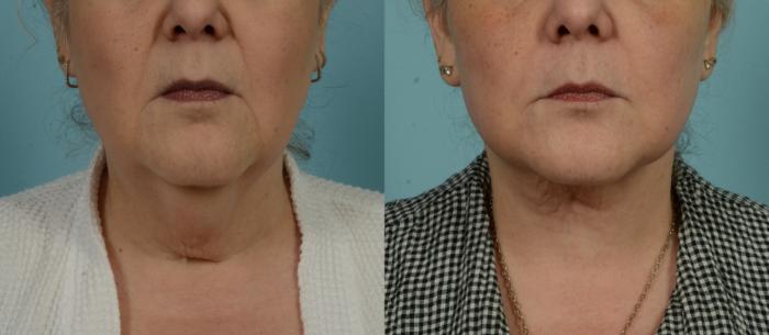 Before & After (cropped) Neck Lift by Dr. Mustoe Case 995 Front View in Chicago, IL