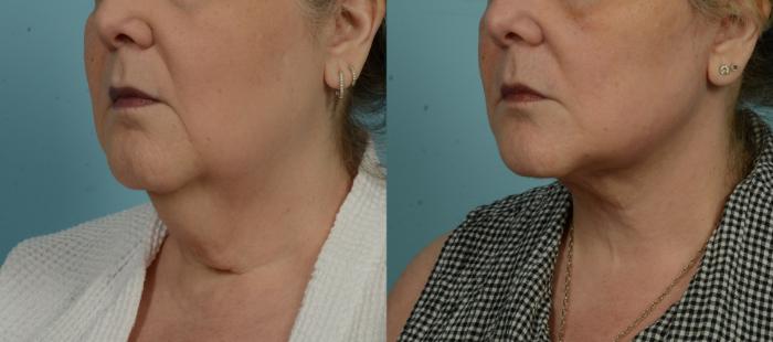 Before & After (cropped) Neck Lift by Dr. Mustoe Case 995 Left Oblique View in Chicago, IL