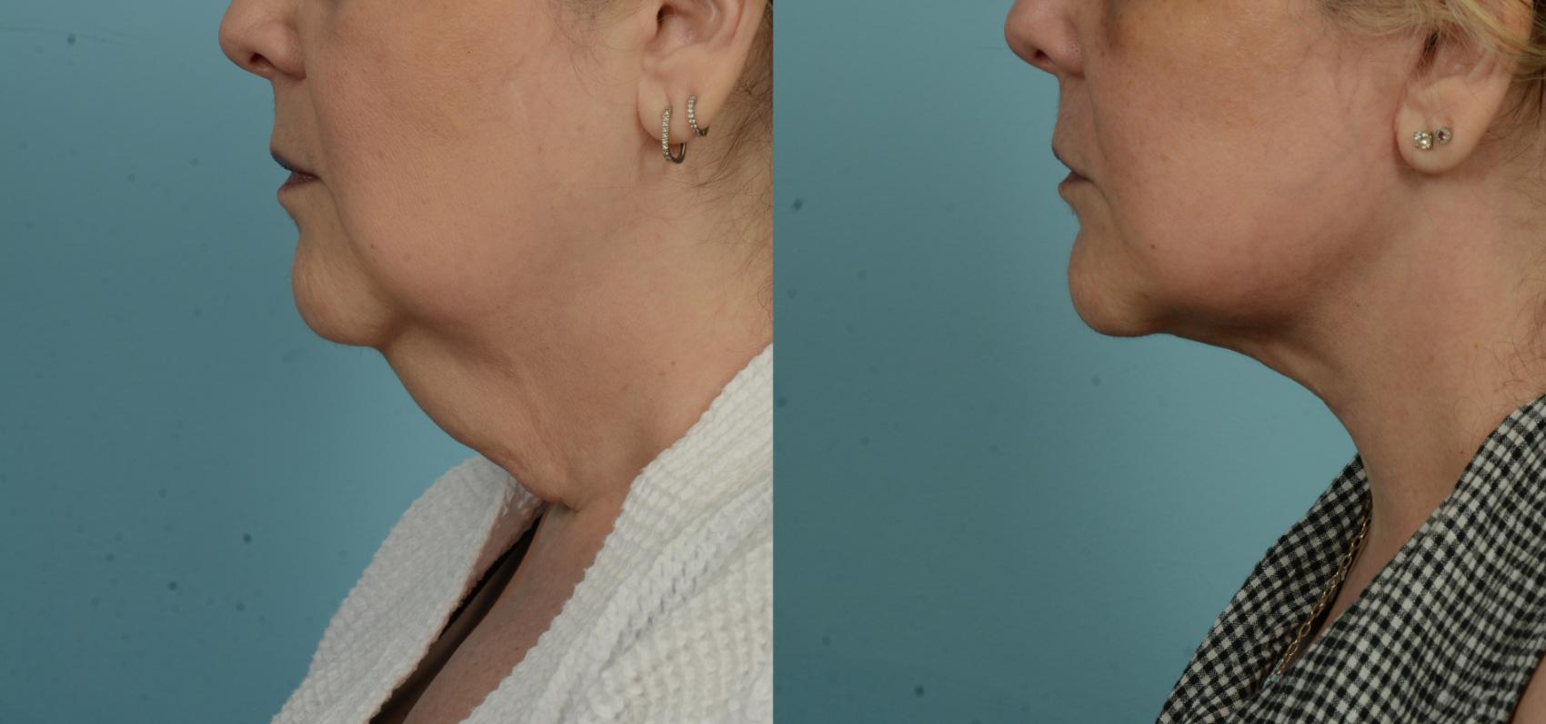 Before & After (cropped) Neck Lift by Dr. Mustoe Case 995 Left Side View in Chicago, IL