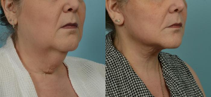 Before & After (cropped) Neck Lift by Dr. Mustoe Case 995 Right Oblique View in Chicago, IL