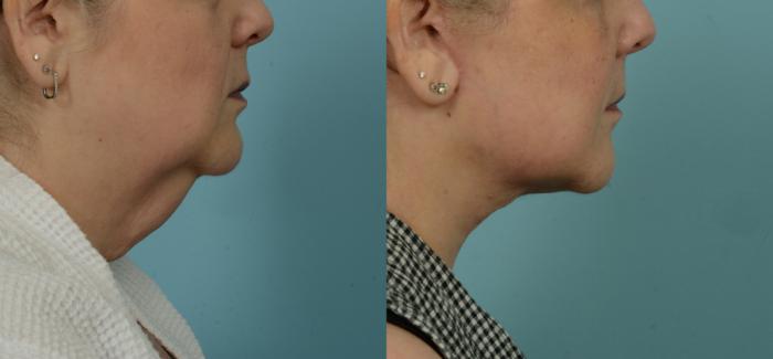 Before & After (cropped) Neck Lift by Dr. Mustoe Case 995 Right Side View in Chicago, IL