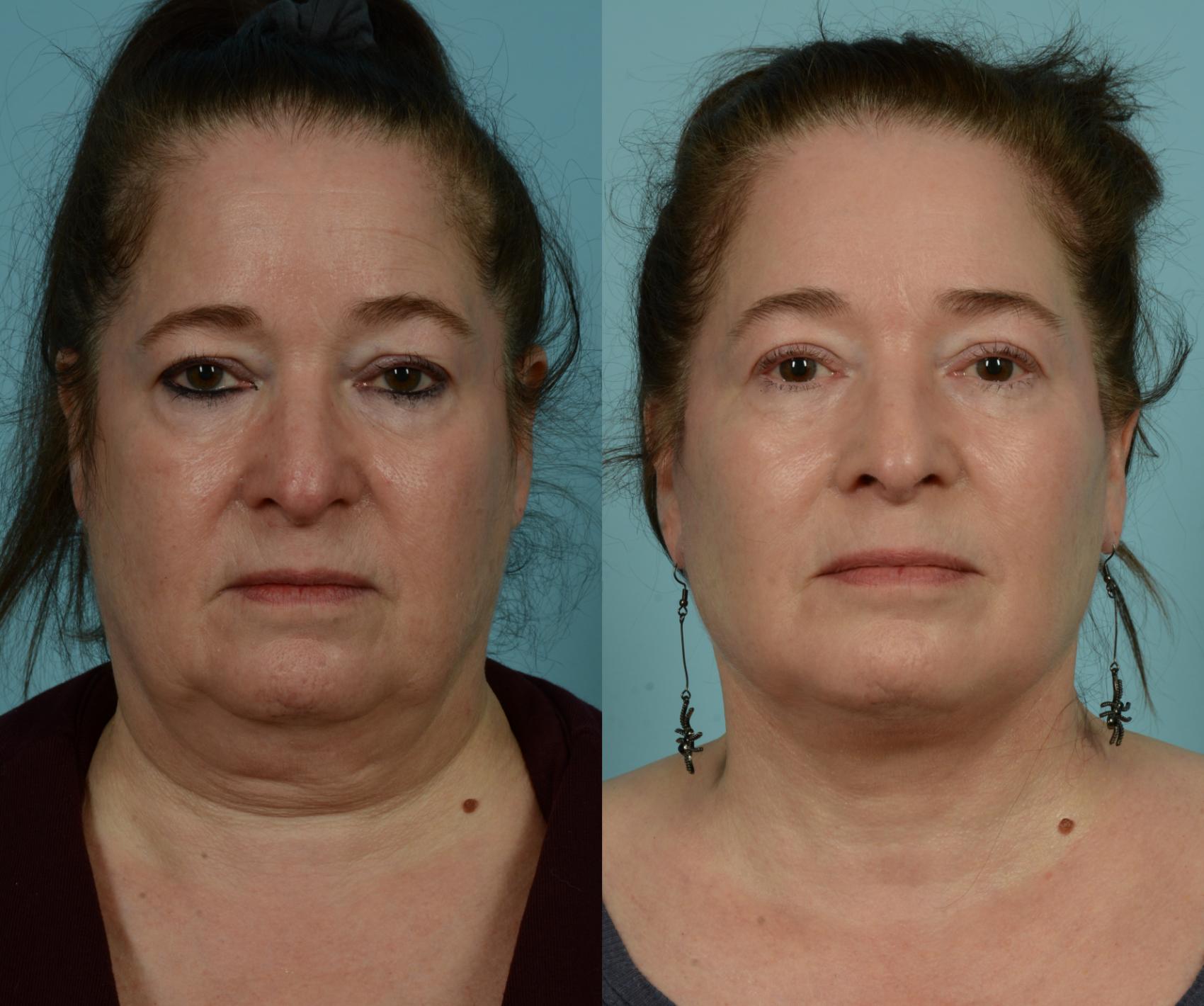 Before & After Deep Plane Facelift by Dr. Mustoe Case 1015 Front View in Chicago, IL