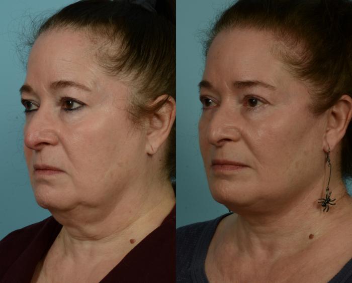 Before & After Deep Plane Facelift by Dr. Mustoe Case 1015 Left Oblique View in Chicago, IL