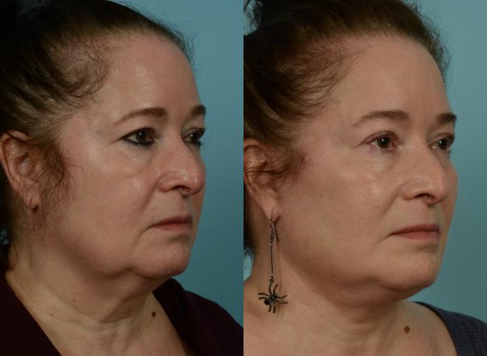 Before & After Deep Plane Facelift by Dr. Mustoe Case 1015 Right Oblique View in Chicago, IL