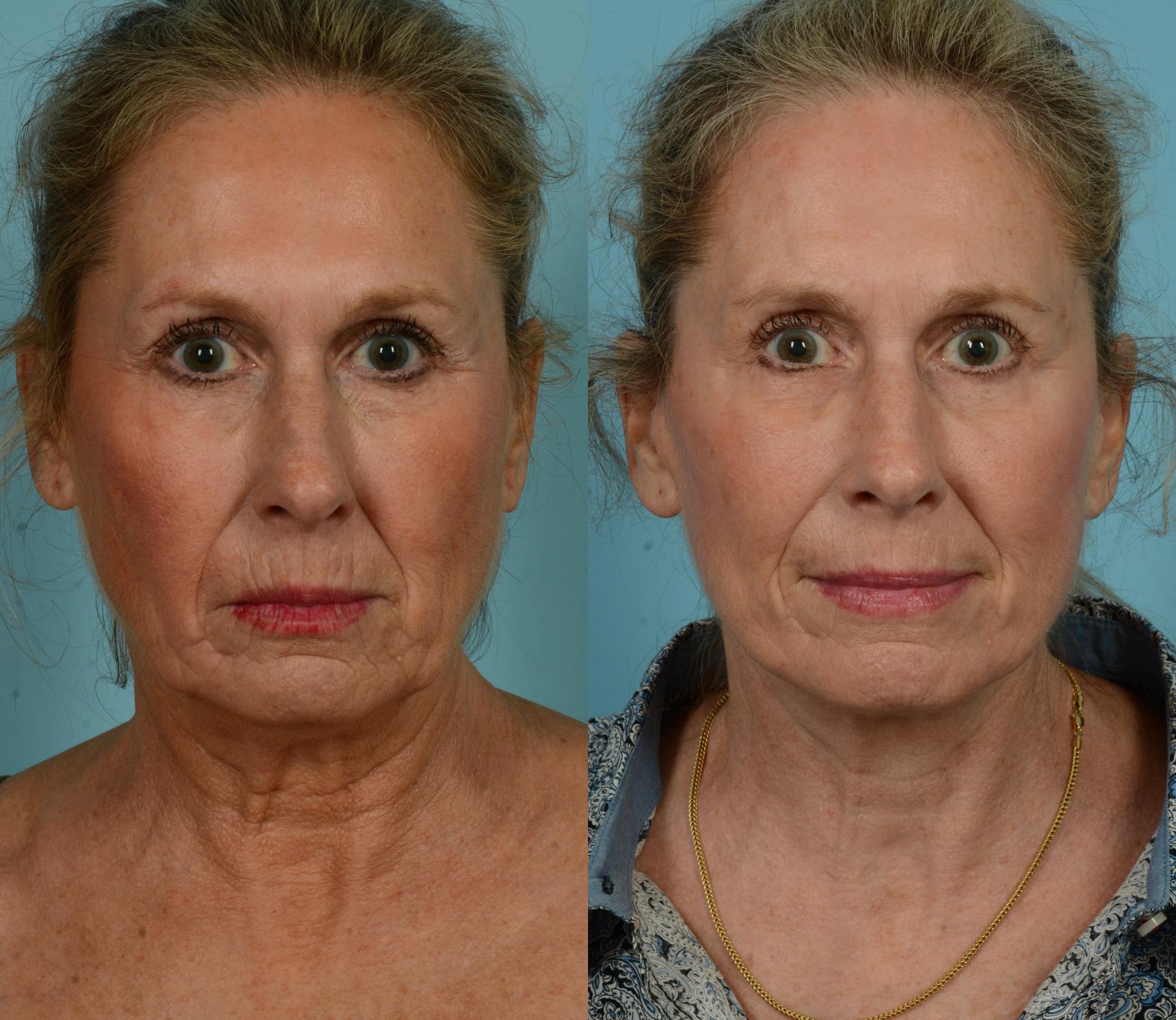 Before & After Fat Grafting by Dr. Mustoe Case 1023 Front View in Chicago, IL