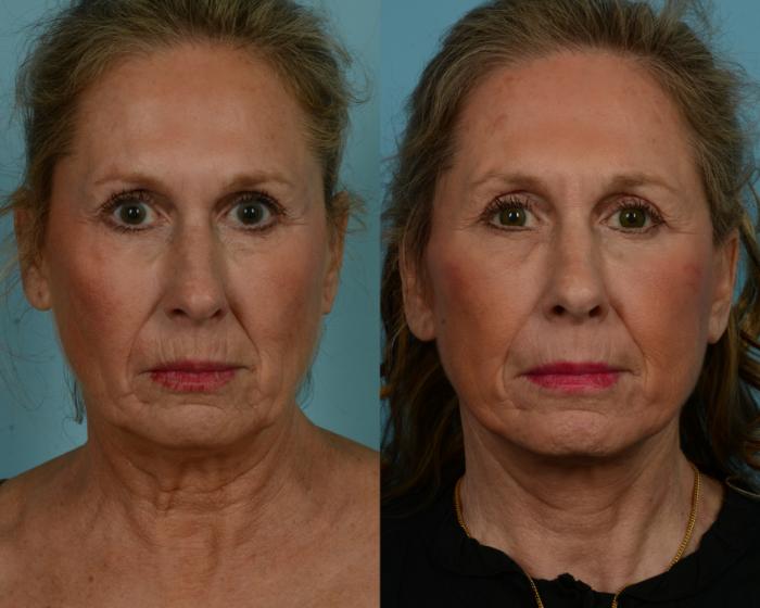 Before & After Deep Plane Facelift by Dr. Mustoe Case 1023 Front View in Chicago, IL