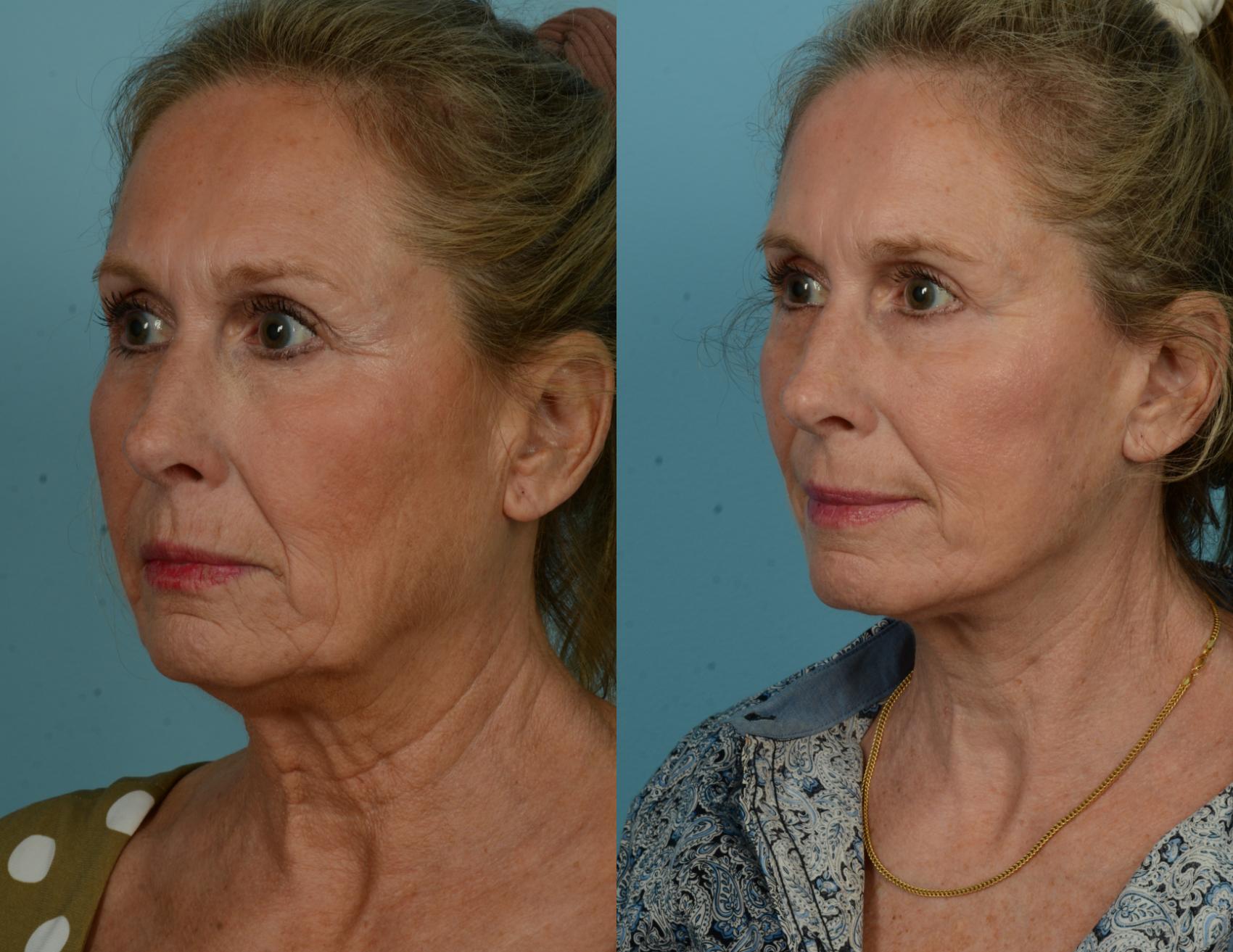 Before & After Deep Plane Facelift by Dr. Mustoe Case 1023 Left Oblique View in Chicago, IL