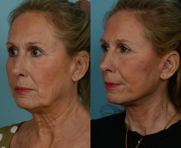 Before & After Deep Plane Facelift by Dr. Mustoe Case 1023 Left Oblique View in Chicago, IL