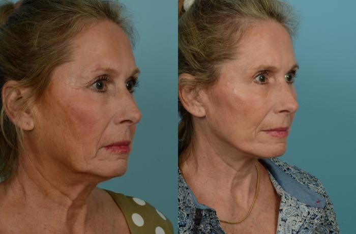 Before & After Deep Plane Facelift by Dr. Mustoe Case 1023 Right Oblique View in Chicago, IL