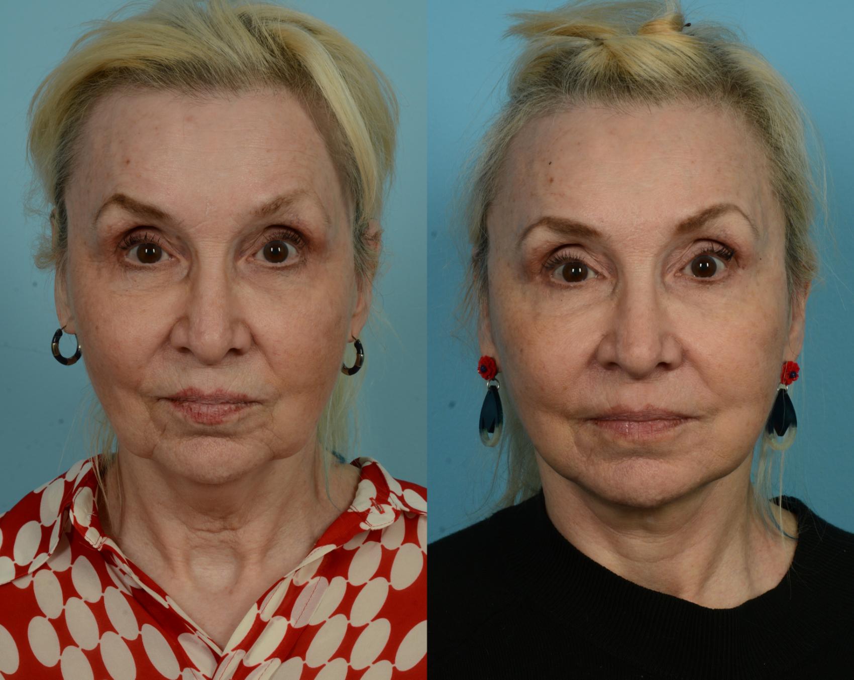 Before & After Deep Plane Facelift by Dr. Mustoe Case 1035 Front View in Chicago, IL