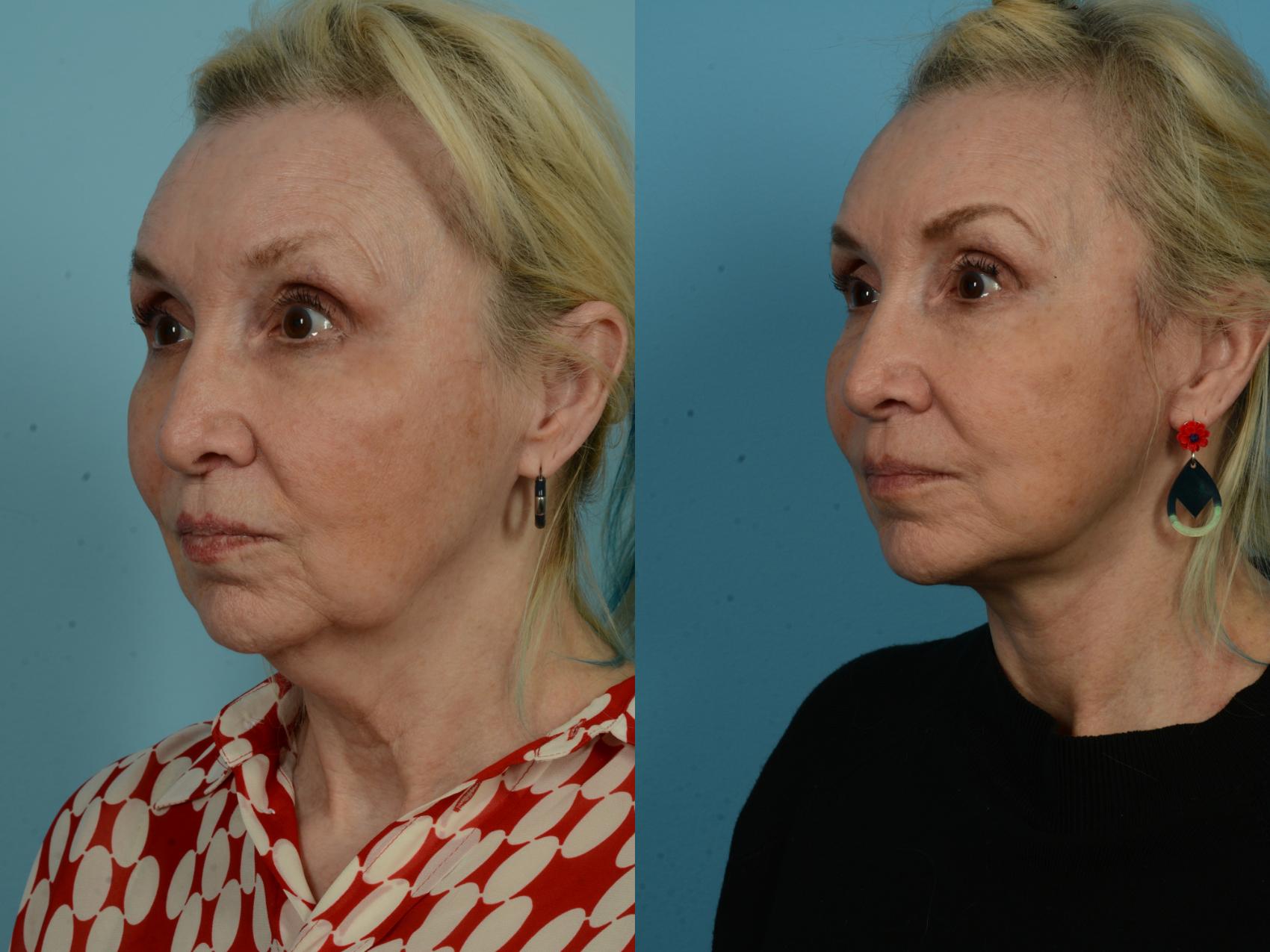 Before & After Deep Plane Facelift by Dr. Mustoe Case 1035 Left Oblique View in Chicago, IL
