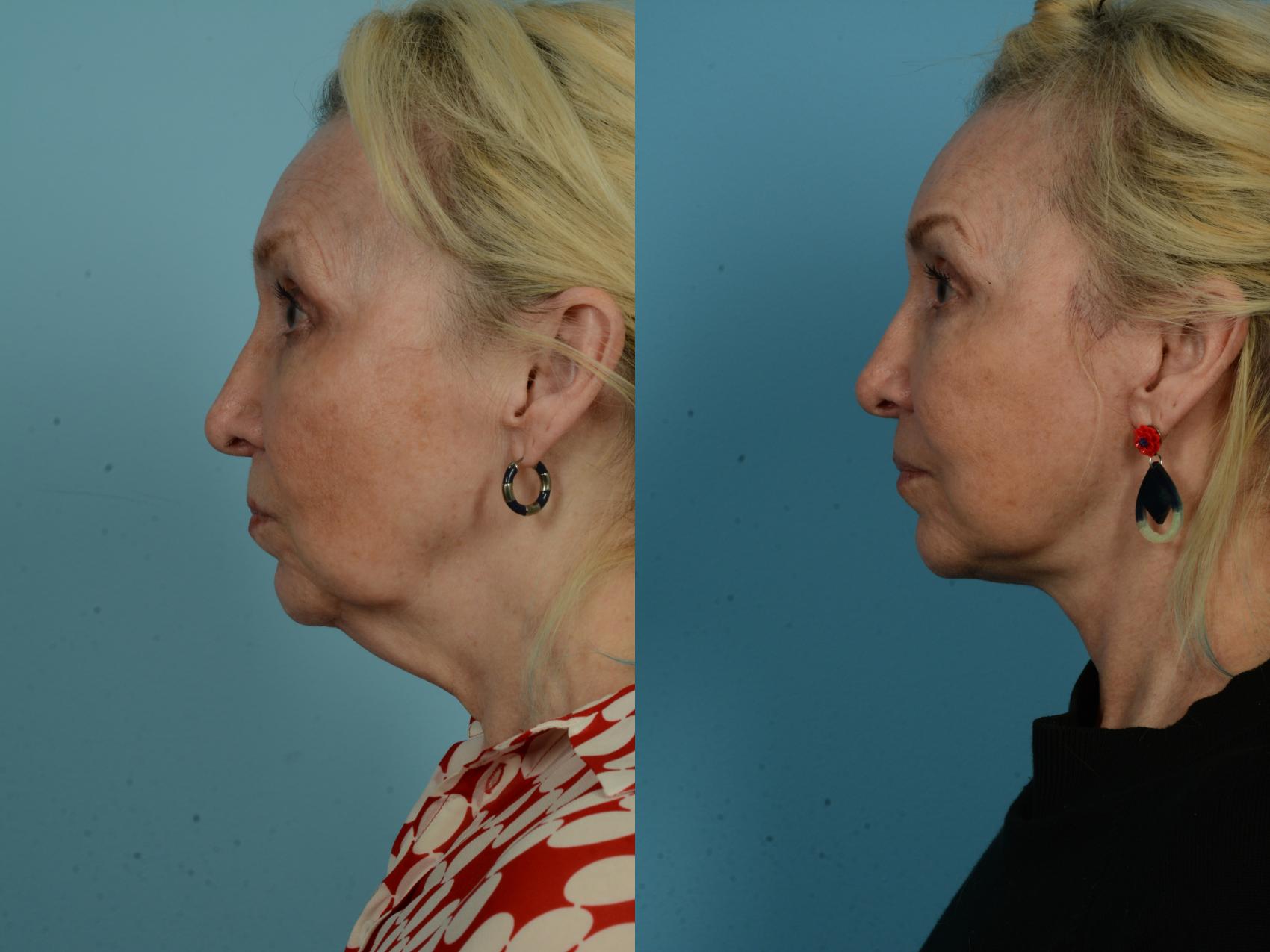 Before & After Deep Plane Facelift by Dr. Mustoe Case 1035 Left Side View in Chicago, IL