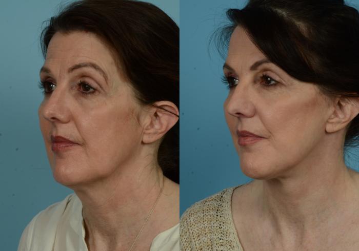 Before & After Deep Plane Facelift by Dr. Mustoe Case 1036 Left Oblique View in Chicago, IL