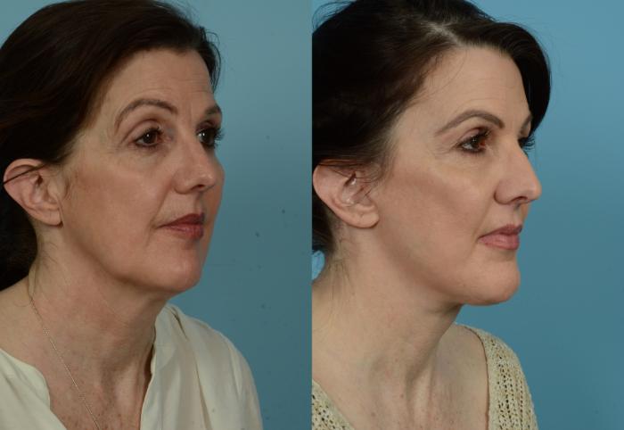 Before & After Deep Plane Facelift by Dr. Mustoe Case 1036 Right Oblique View in Chicago, IL