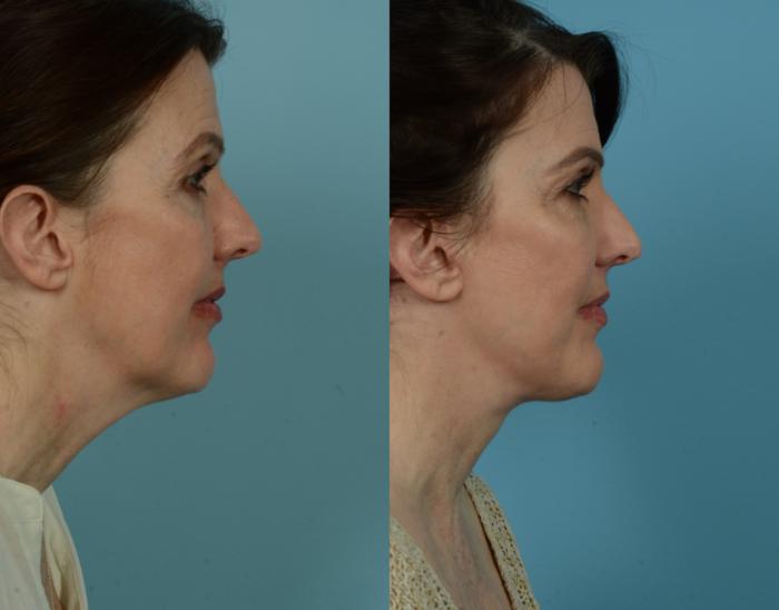 Before & After Deep Plane Facelift by Dr. Mustoe Case 1036 Right Side View in Chicago, IL