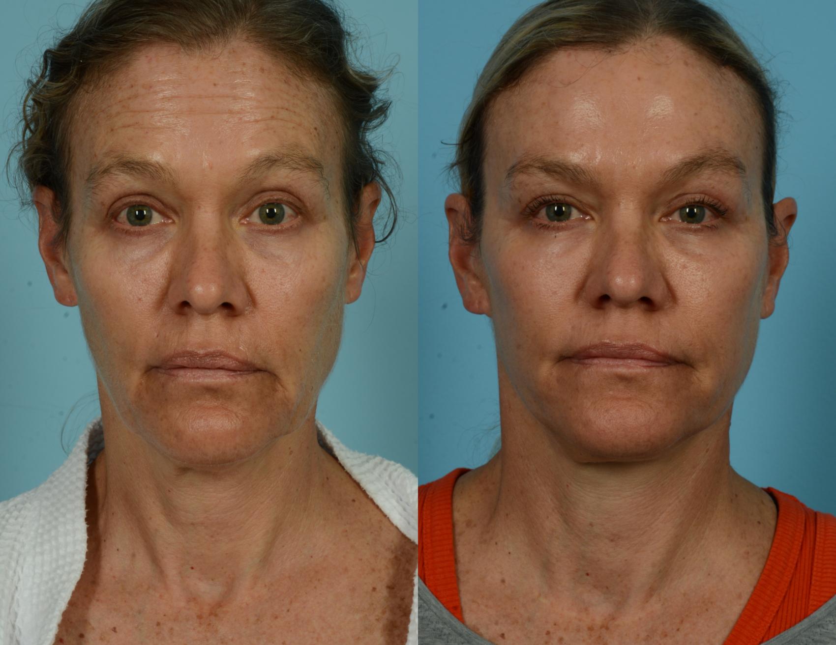 Before & After Deep Plane Facelift by Dr. Mustoe Case 1040 Front View in Chicago, IL