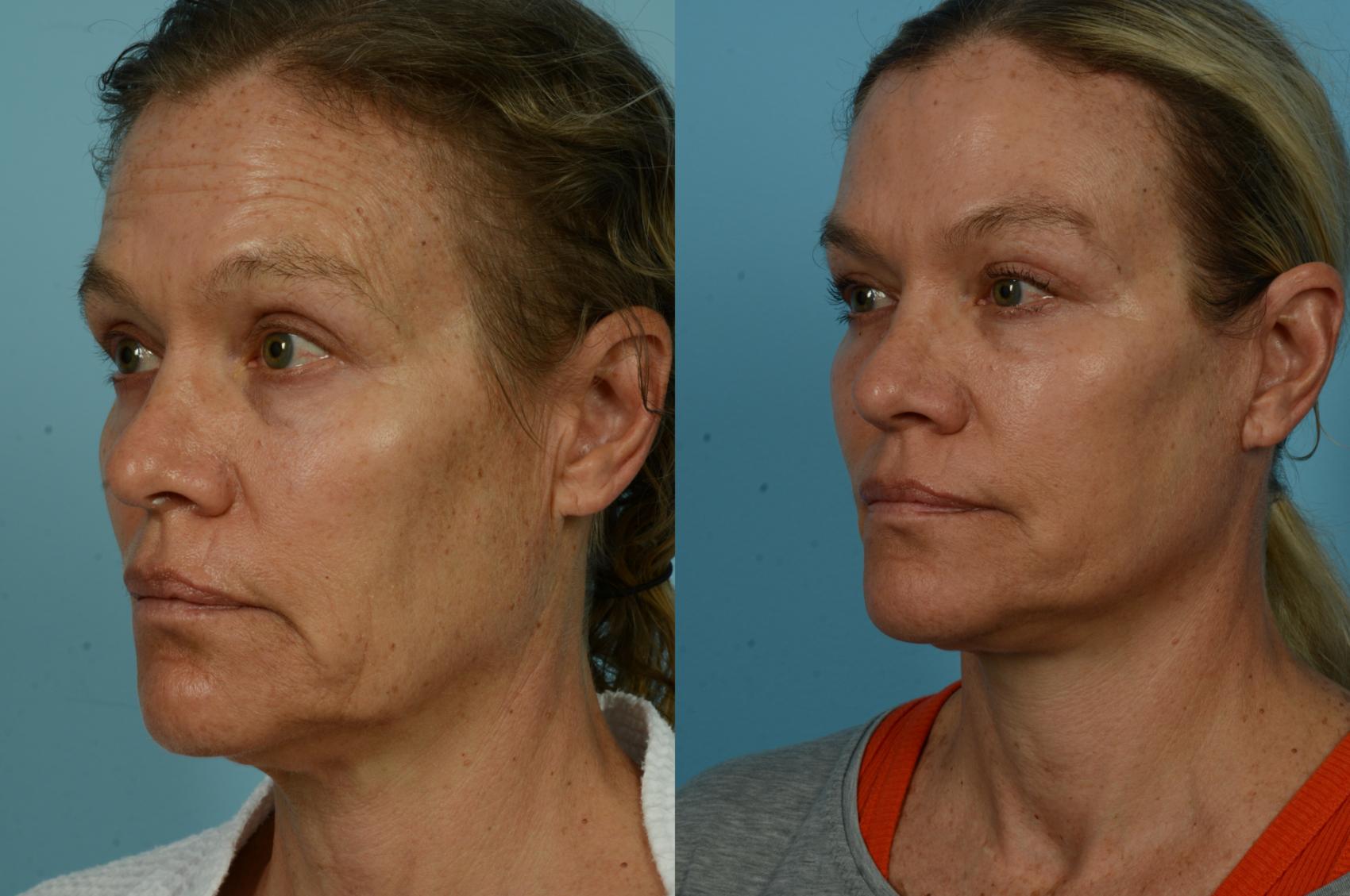 Before & After Deep Plane Facelift by Dr. Mustoe Case 1040 Left Oblique View in Chicago, IL