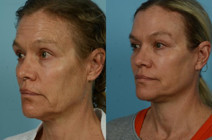Before & After Deep Plane Facelift by Dr. Mustoe Case 1040 Left Oblique View in Chicago, IL