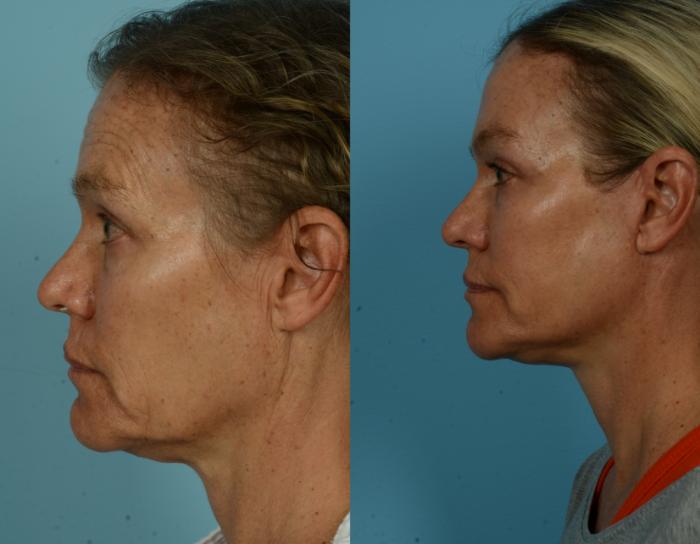 Before & After Deep Plane Facelift by Dr. Mustoe Case 1040 Left Side View in Chicago, IL