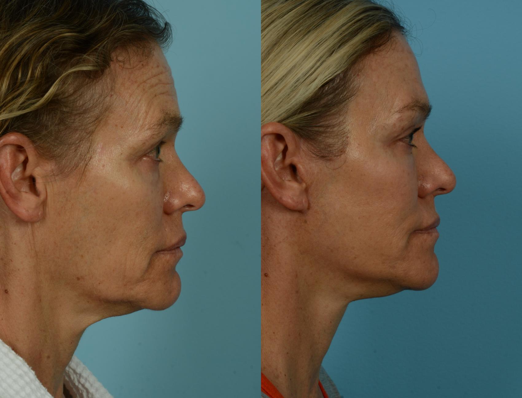 Before & After Deep Plane Facelift by Dr. Mustoe Case 1040 Right Side View in Chicago, IL