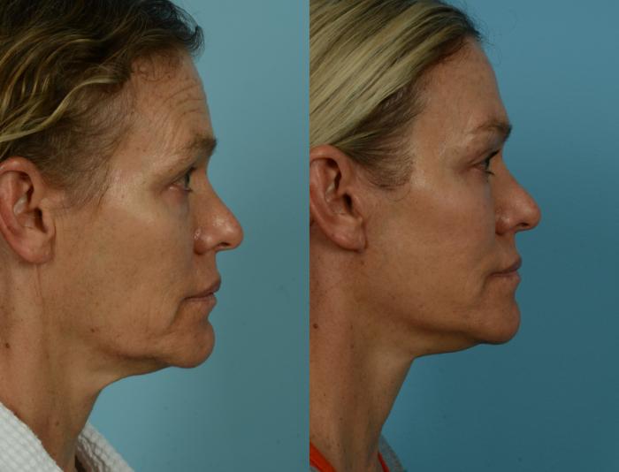 Before & After Deep Plane Facelift by Dr. Mustoe Case 1040 Right Side View in Chicago, IL