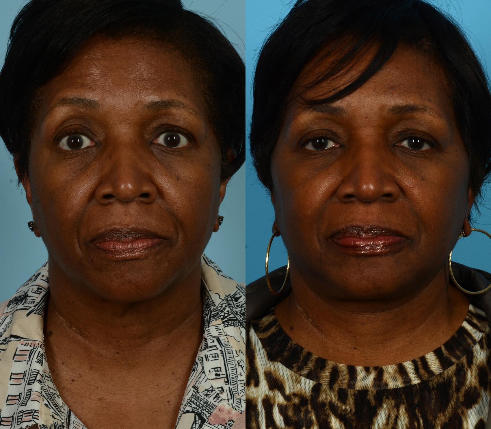 Before & After Neck Lift by Dr. Mustoe Case 1042 Front View in Chicago, IL