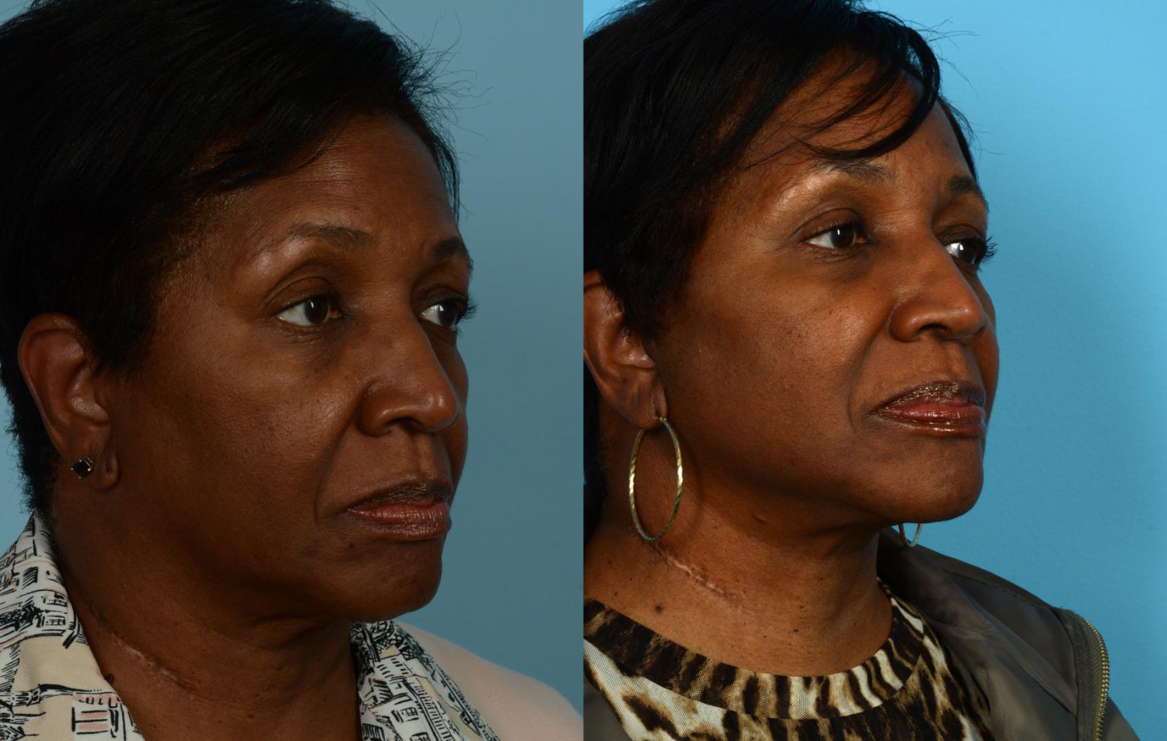 Before & After Neck Lift by Dr. Mustoe Case 1042 Right Oblique View in Chicago, IL