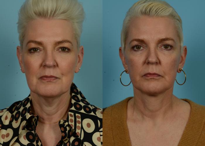 Before & After Deep Plane Facelift by Dr. Mustoe Case 1046 Front View in Chicago, IL