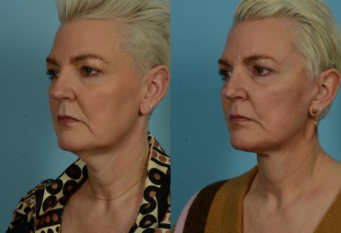 Before & After Deep Plane Facelift by Dr. Mustoe Case 1046 Left Oblique View in Chicago, IL