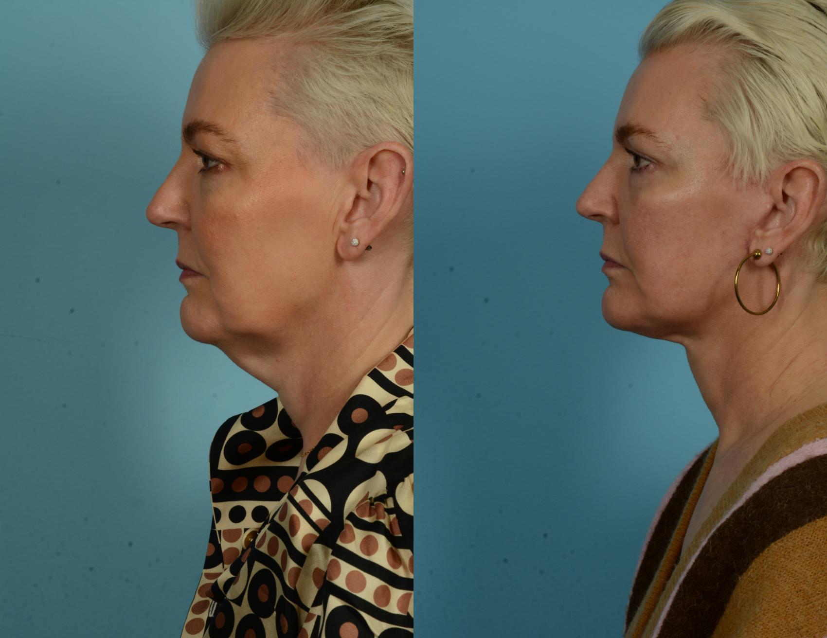 Before & After Deep Plane Facelift by Dr. Mustoe Case 1046 Left Side View in Chicago, IL