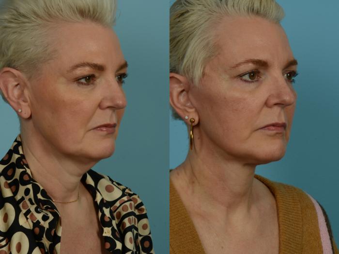 Before & After Deep Plane Facelift by Dr. Mustoe Case 1046 Right Oblique View in Chicago, IL