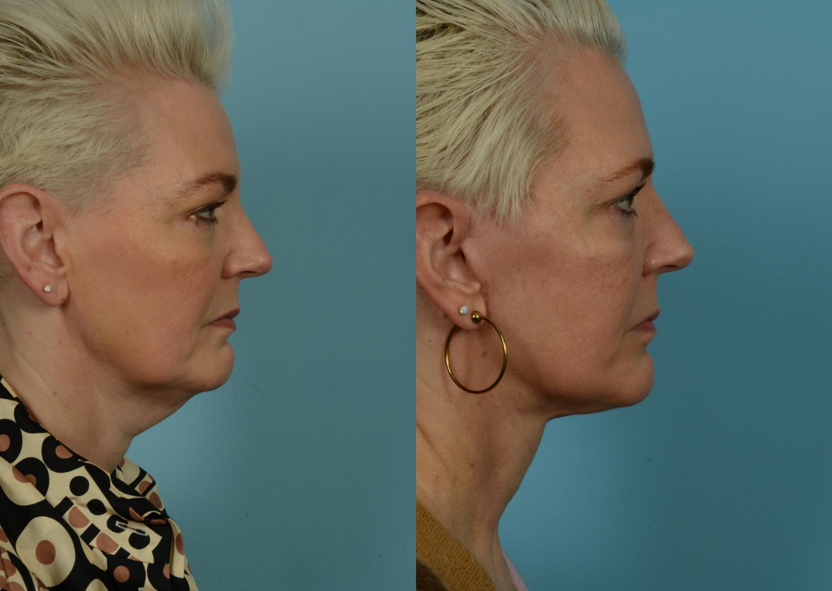 Before & After Deep Plane Facelift by Dr. Mustoe Case 1046 Right Side View in Chicago, IL