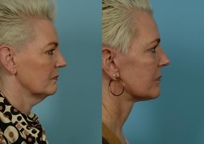 Before & After Deep Plane Facelift by Dr. Mustoe Case 1046 Right Side View in Chicago, IL