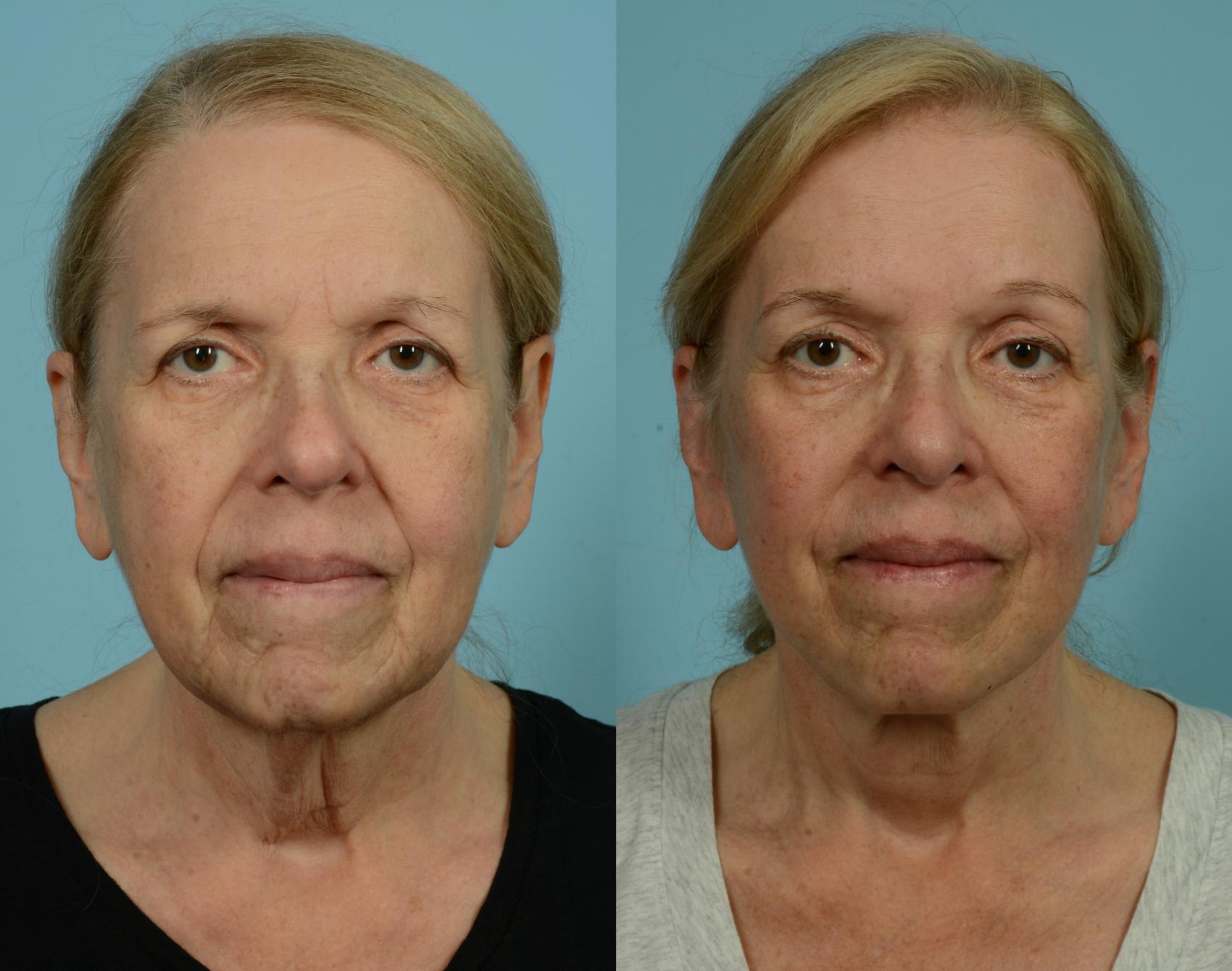 Before & After Deep Plane Facelift by Dr. Mustoe Case 1057 Front View in Chicago, IL