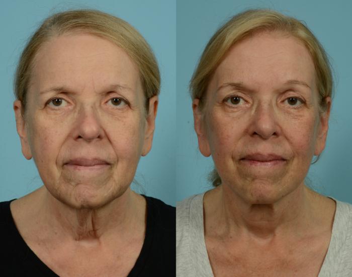 Before & After Deep Plane Facelift by Dr. Mustoe Case 1057 Front View in Chicago, IL