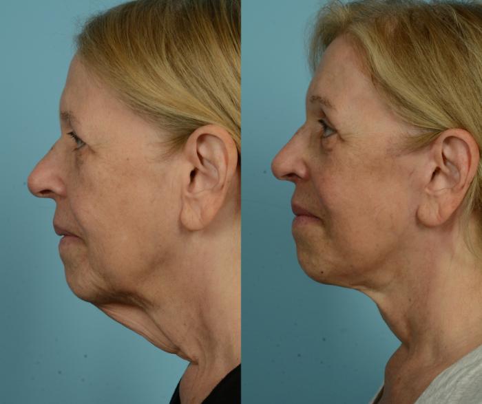 Before & After Deep Plane Facelift by Dr. Mustoe Case 1057 Left Side View in Chicago, IL