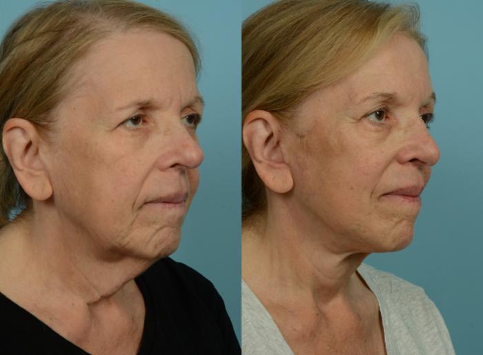 Before & After Deep Plane Facelift by Dr. Mustoe Case 1057 Right Oblique View in Chicago, IL