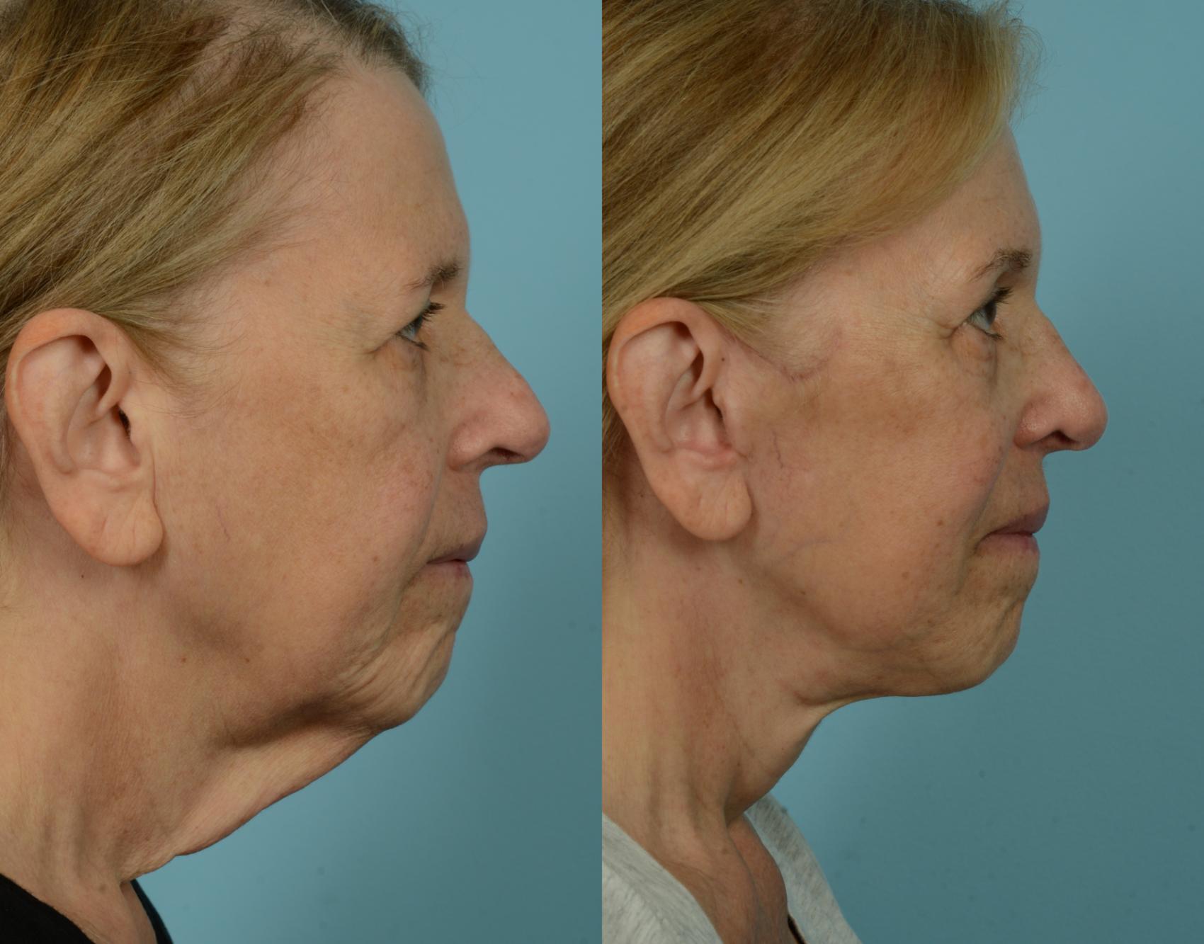 Before & After Deep Plane Facelift by Dr. Mustoe Case 1057 Right Side View in Chicago, IL