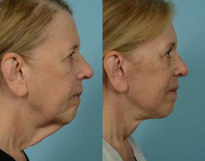 Before & After Deep Plane Facelift by Dr. Mustoe Case 1057 Right Side View in Chicago, IL