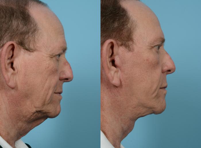 Before & After Deep Plane Facelift by Dr. Mustoe Case 1072 Right Side View in Chicago, IL