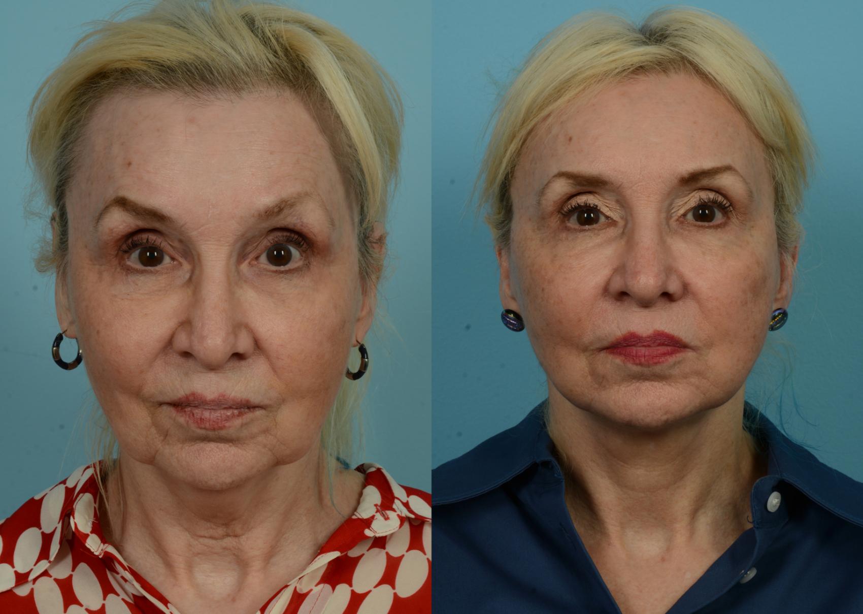 Before & After Neck Lift by Dr. Mustoe Case 1074 Front View in Chicago, IL