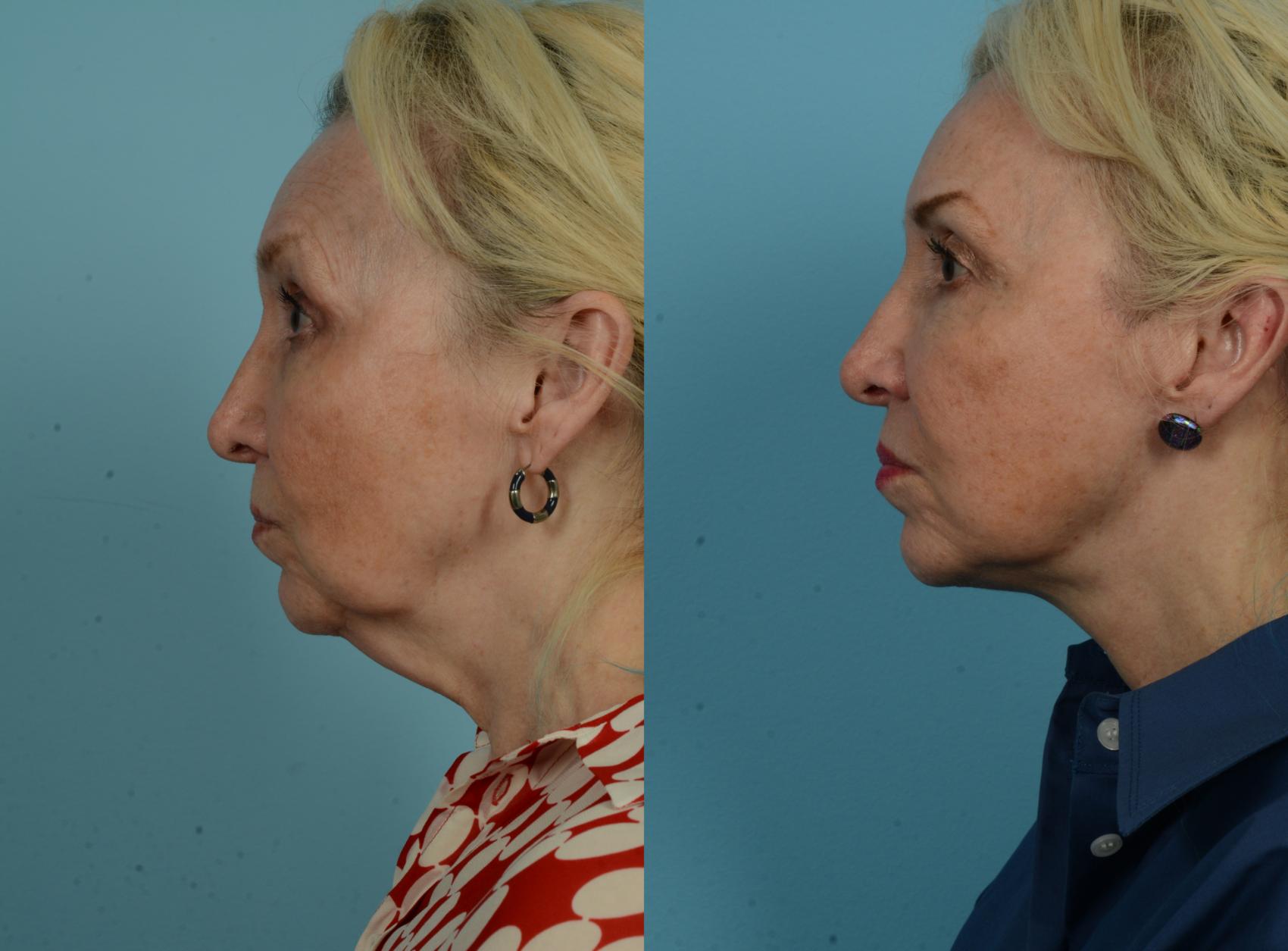 Before & After Neck Lift by Dr. Mustoe Case 1074 Left Side View in Chicago, IL
