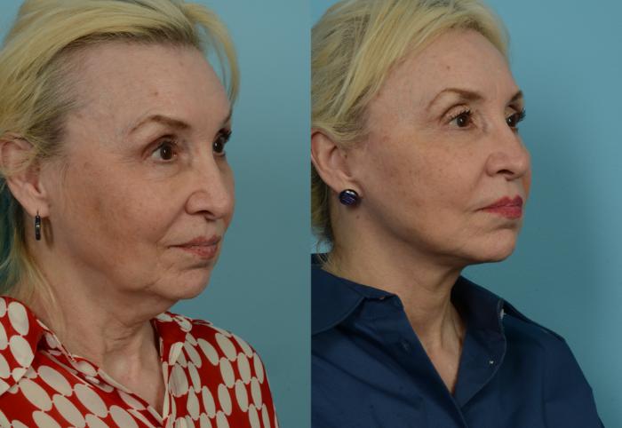 Before & After Deep Plane Facelift by Dr. Mustoe Case 1074 Right Oblique View in Chicago, IL