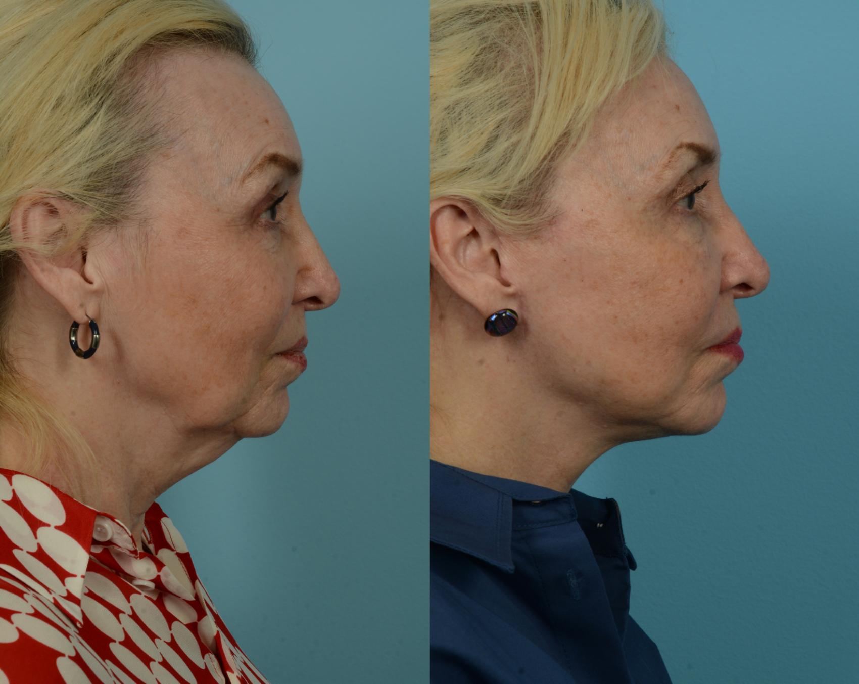 Before & After Neck Lift by Dr. Mustoe Case 1074 Right Side View in Chicago, IL