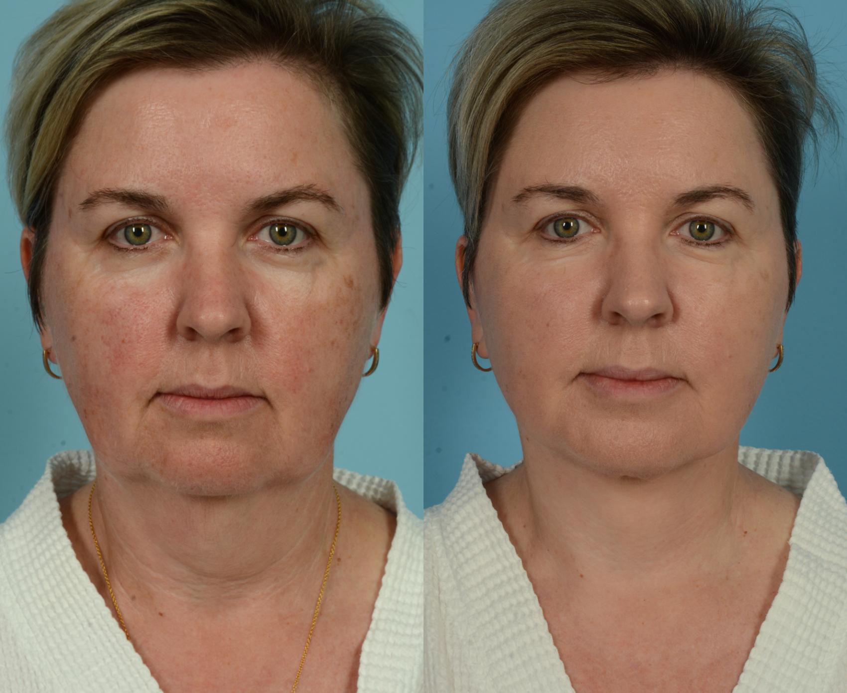 Before & After Neck Lift by Dr. Mustoe Case 1079 Front View in Chicago, IL