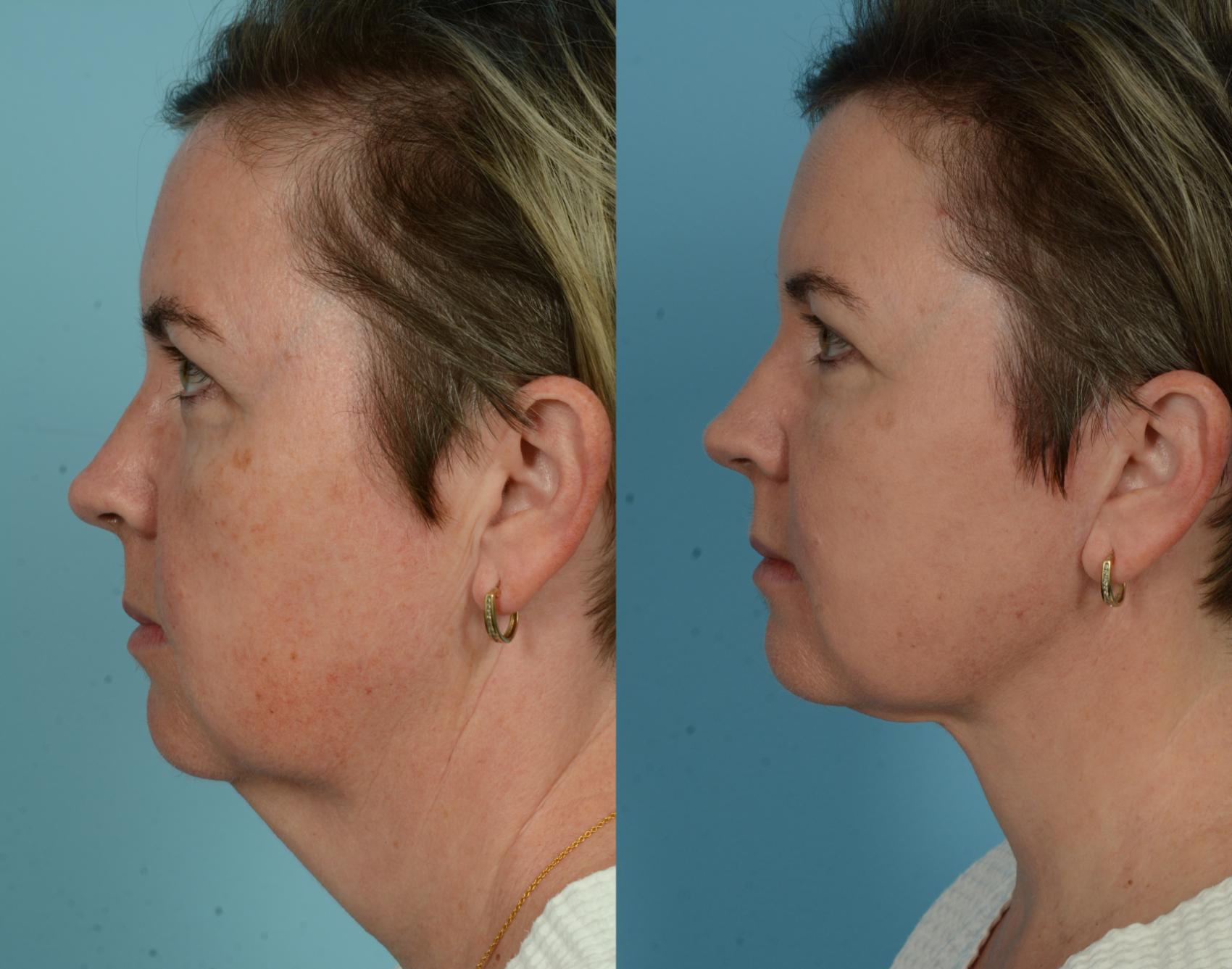 Before & After Neck Lift by Dr. Mustoe Case 1079 Left Side View in Chicago, IL